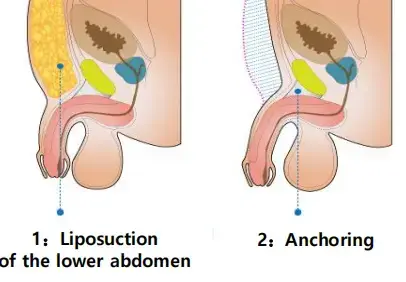 聊聊男性丁丁延长术的手术原理